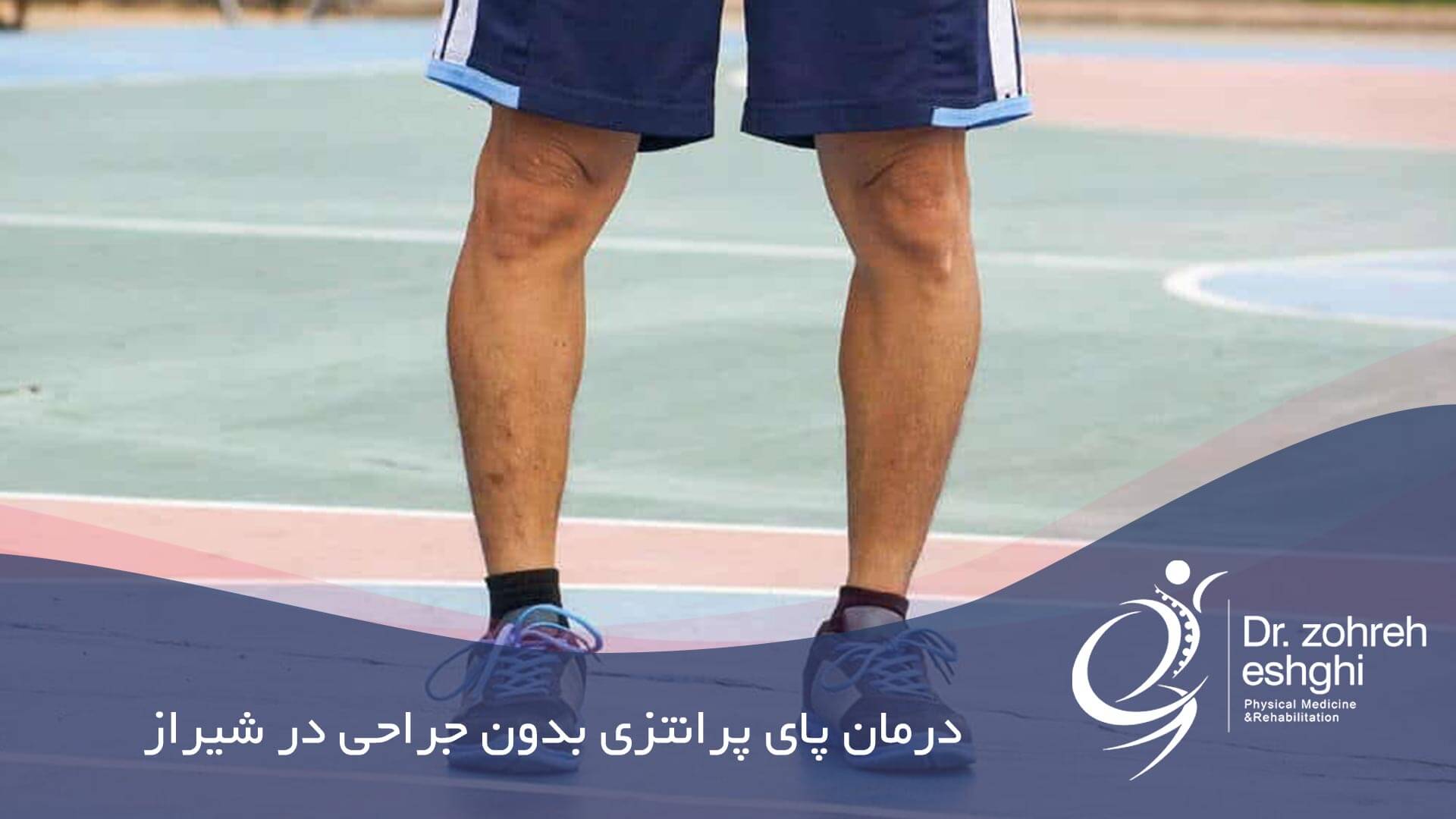 درمان پای پرانتزی بدون جراحی در شیراز