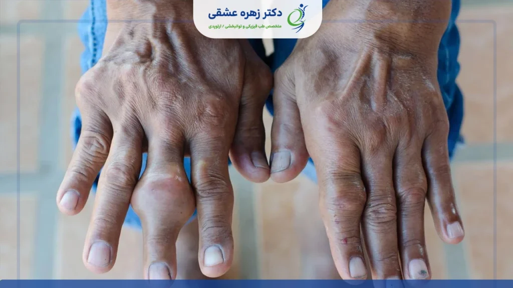 بیماری نقرس و سفتی و خشکی مفصل ها