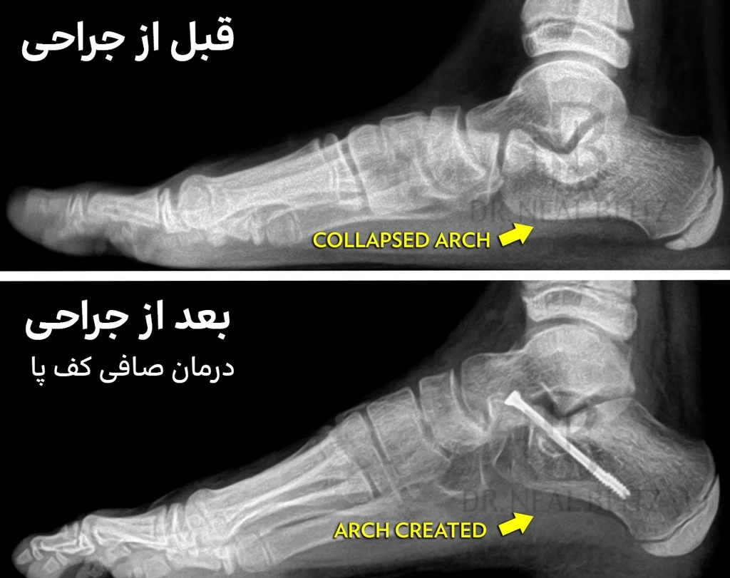 تصویر سی تی اسکن از نتیجه جراحی صافی کف پا