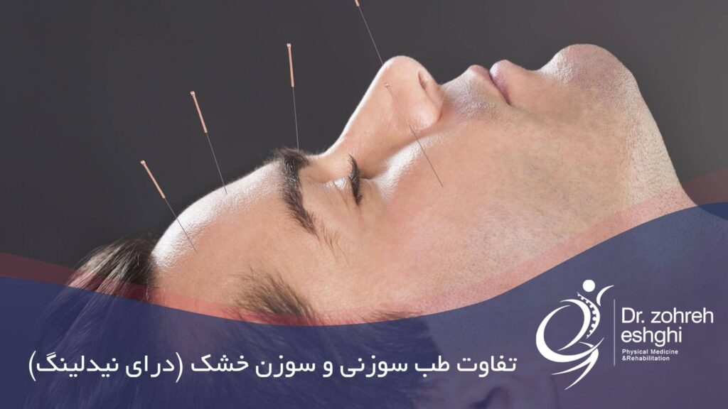 تفاوت طب سوزنی و درای نیدلینگ