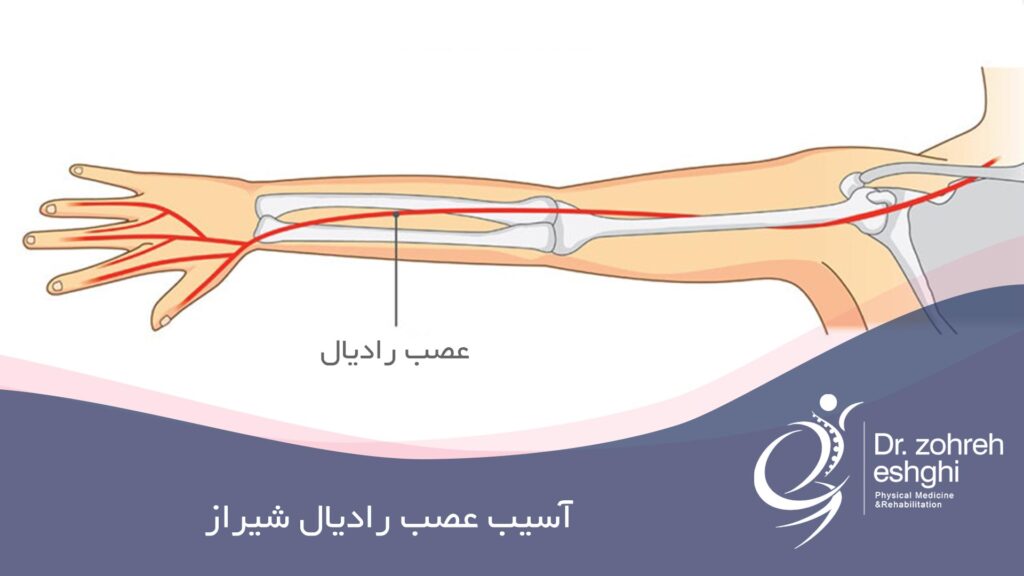 آسیب عصب رادیال شیراز