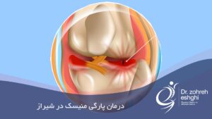 درمان پارگی منیسک در شیراز