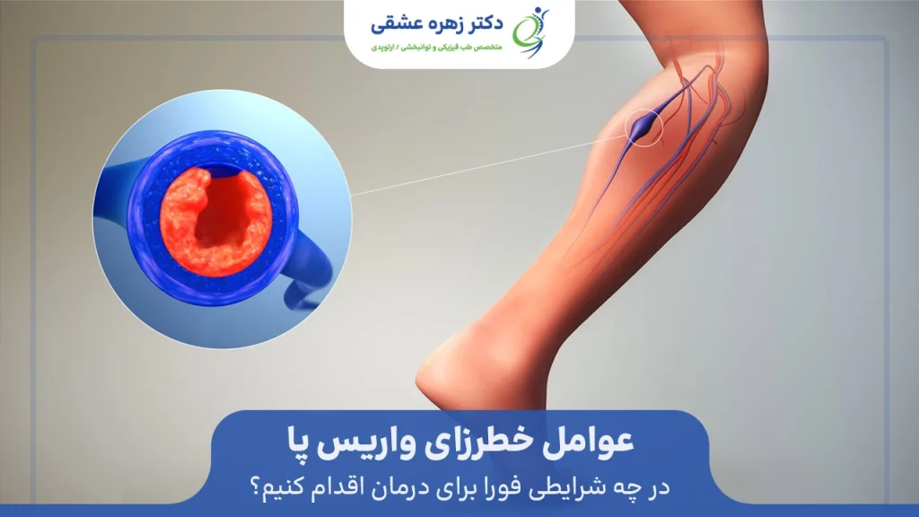 عوامل خطرزا برای مراجعه به متخصص در رگهای واریس پا
