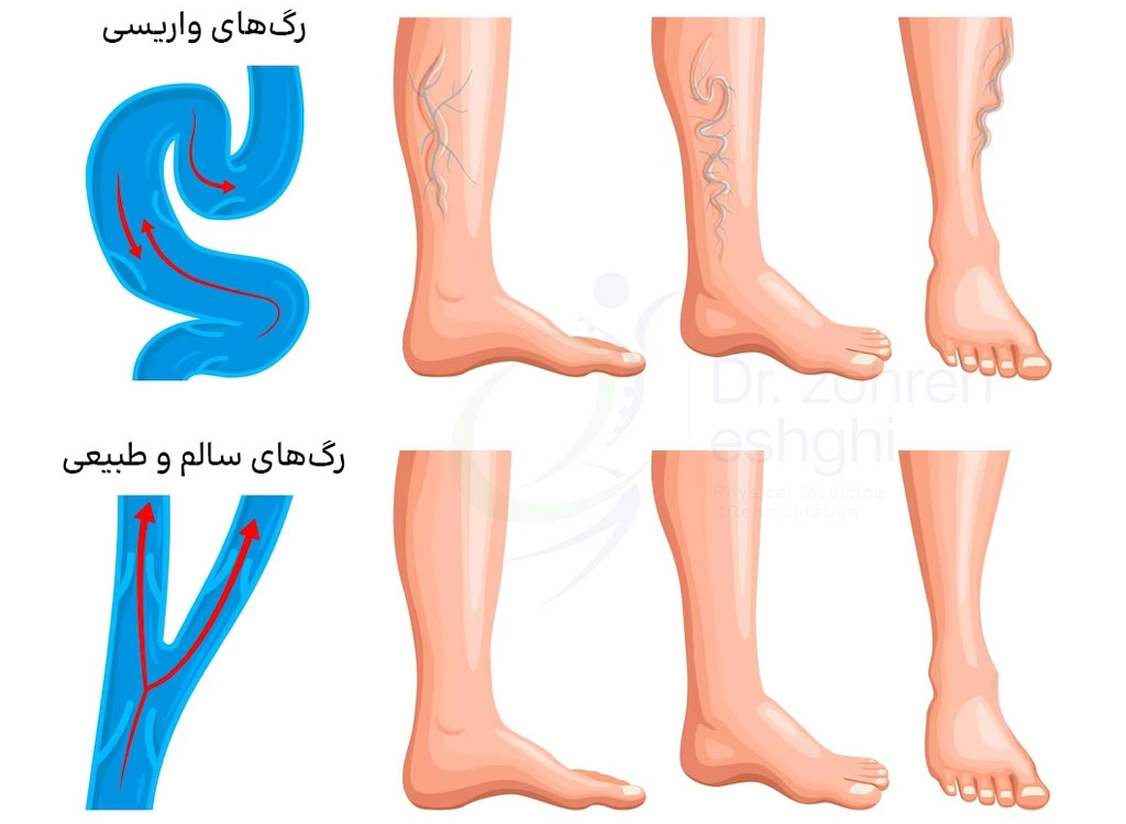 علت رگهای واریسی و پیچ خوردگی رگ ها