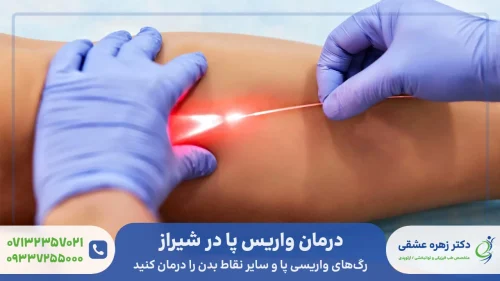درمان رگ های واریسی پا در شیراز