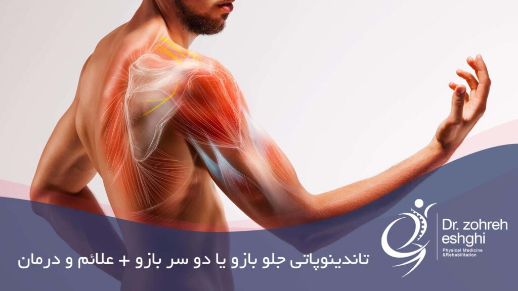 درمان تاندونیت عضله دو سر بازو