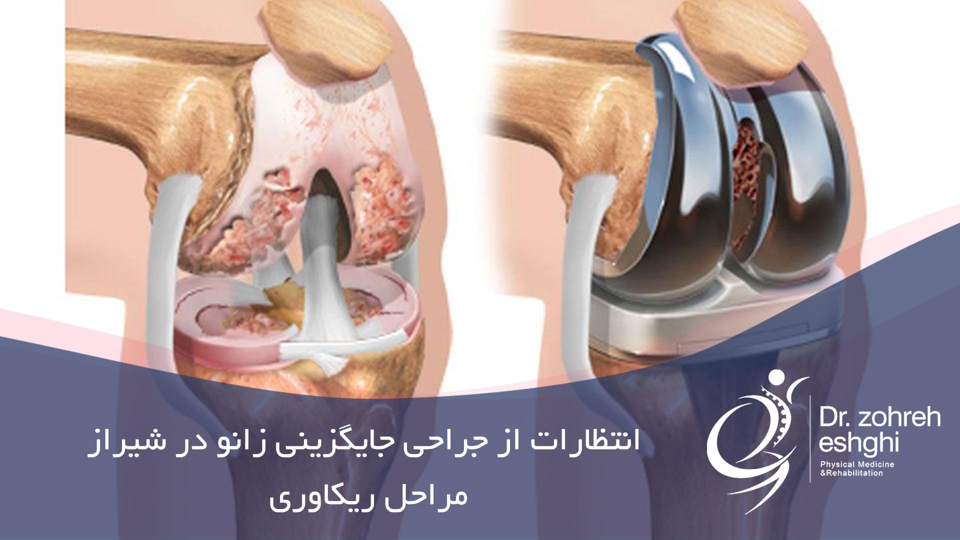 انتظارات از جراحی جایگزینی زانو در شیراز و مراحل ریکاوری