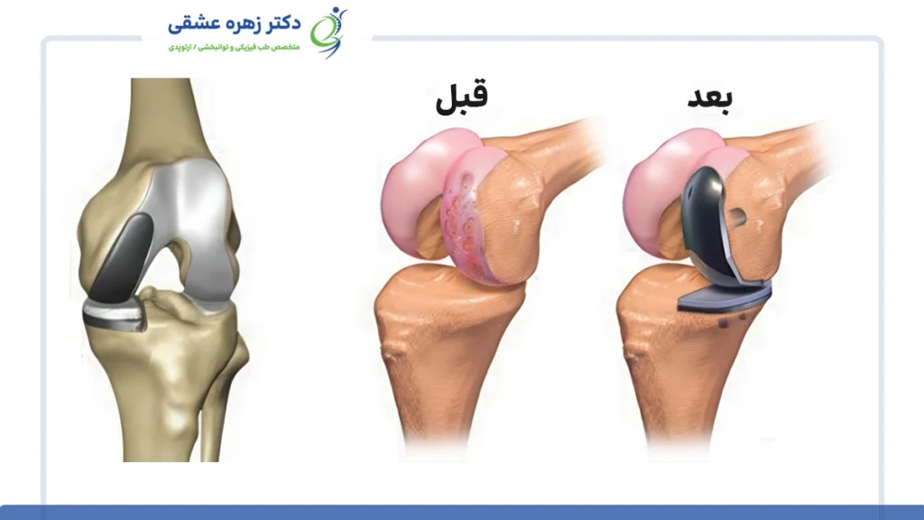 قبل و بعد از جراحی جایگزینی بخشی از مفصل زانو