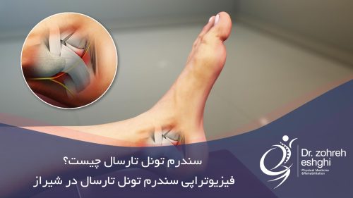 سندرم تونل تارسال