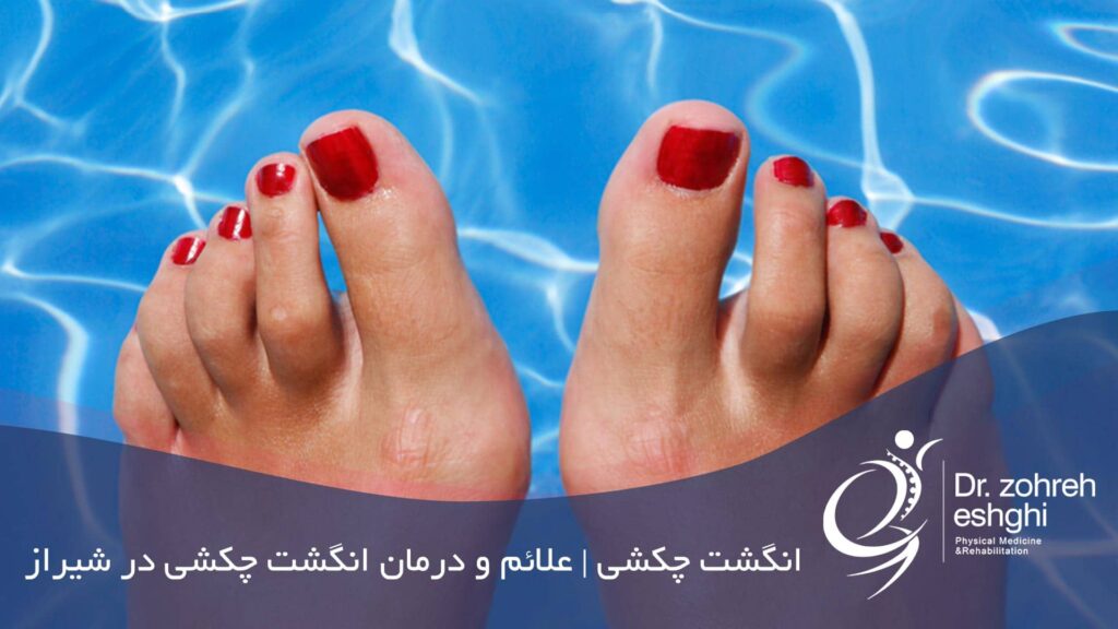 درمان انگشت چکشی پا