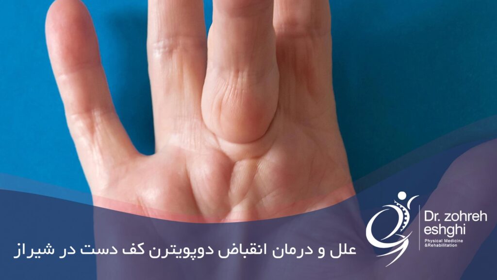 درمان انقباض دوپویترن در شیراز