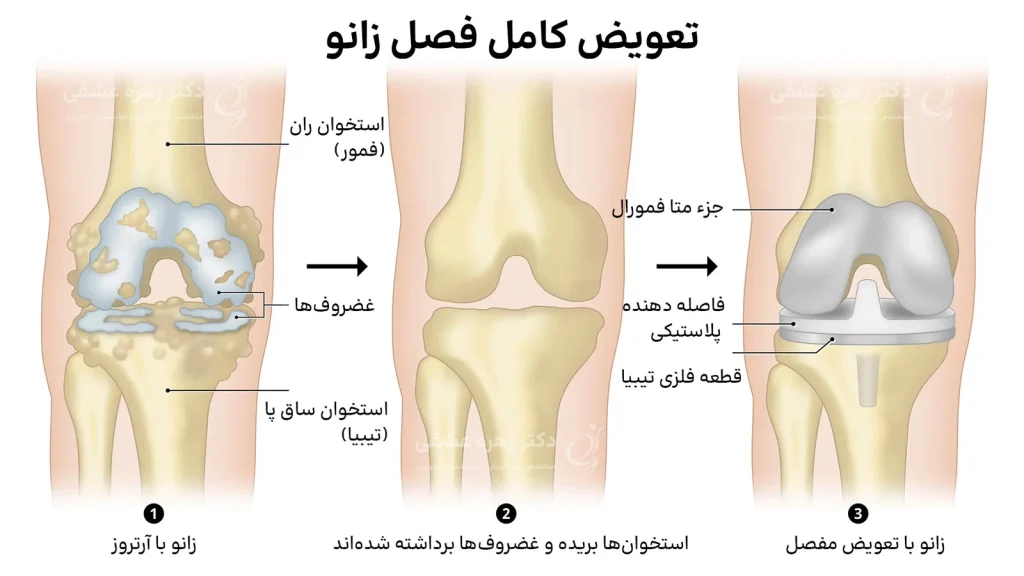 مراحل تعویض کامل مفصل زانو در شیراز در اثر آرتروز زانو