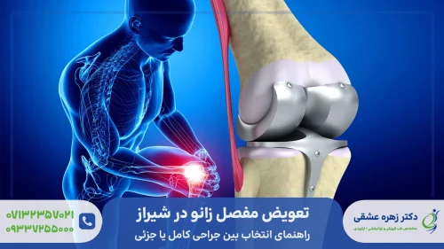 تعویض مفصل زانو در شیراز - بخشی از زانو یا تعویض کامل