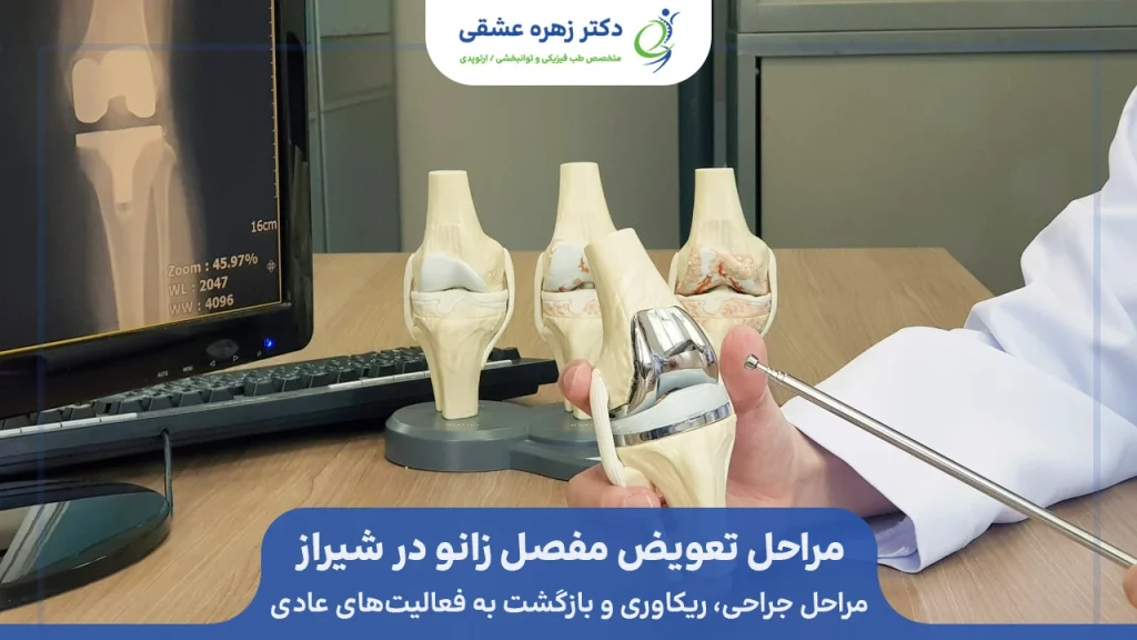 مراحل تعویض مفصل زانو و ریکاوری