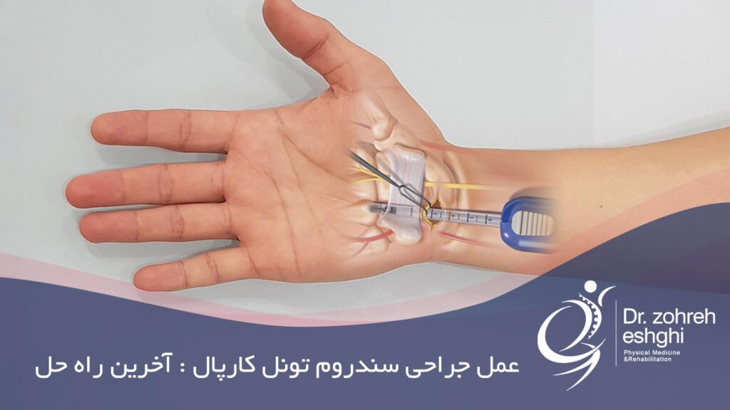 جراحی سندروم تونل کارپال