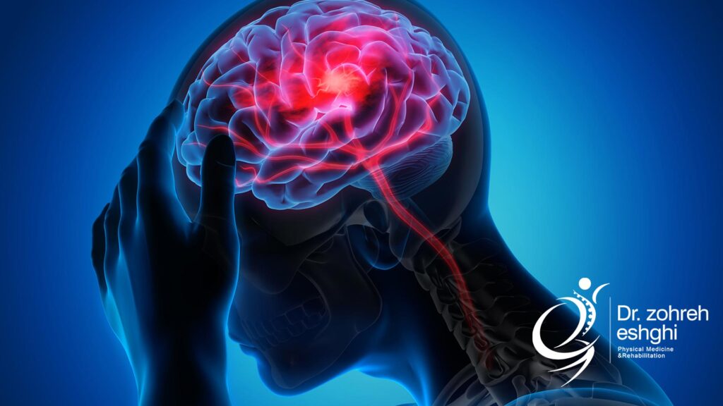 درمان فیزیوتراپی سکته مغزی