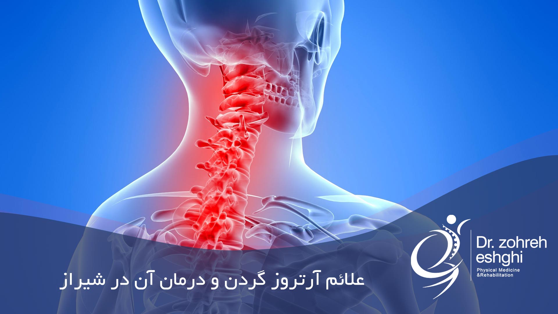 علائم آرتروز گردن و درمان آن در شیراز