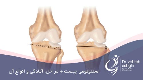 استئوتومی چیست