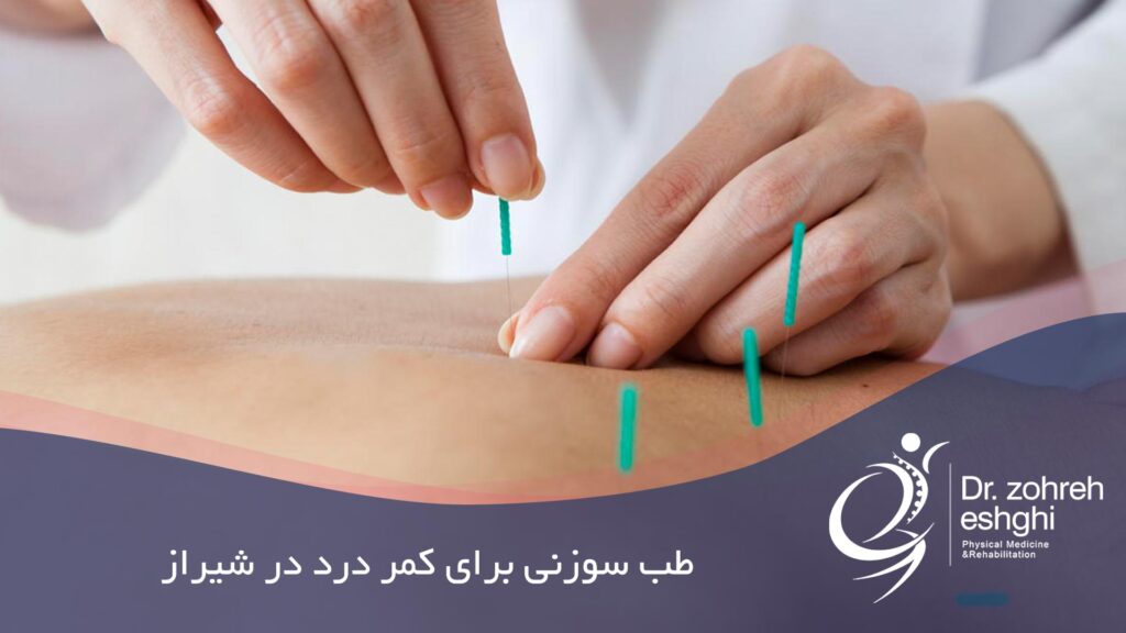 طب سوزنی برای درمان کمر درد در شیراز