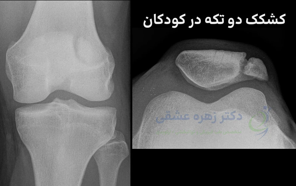 کشکک دو تکه