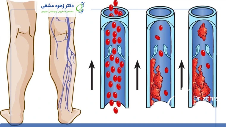 لخته خونی در رگ‌های پا