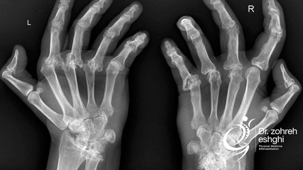 تشخیص آرتروز دست