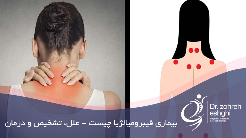 بیماری فیبرومیالژیا چیست