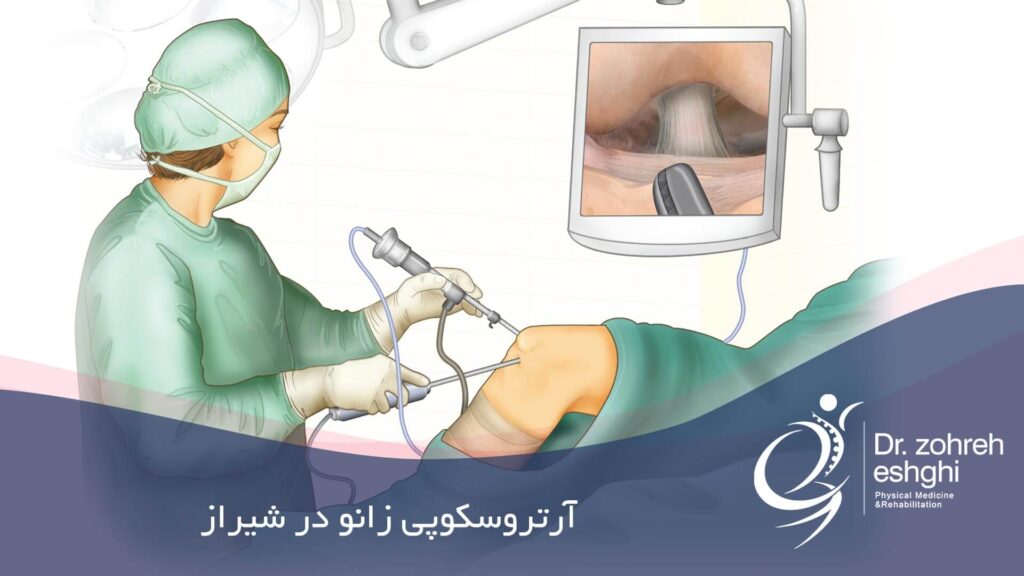 آرتروسکوپی زانو در شیراز