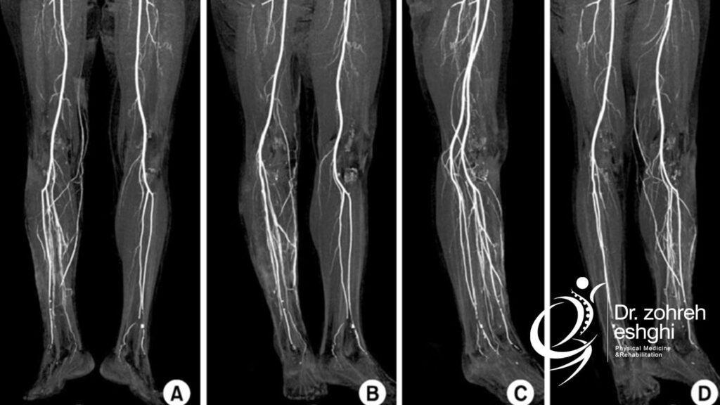 آرتریوگرام برای تشخیص علت درد ساق پا