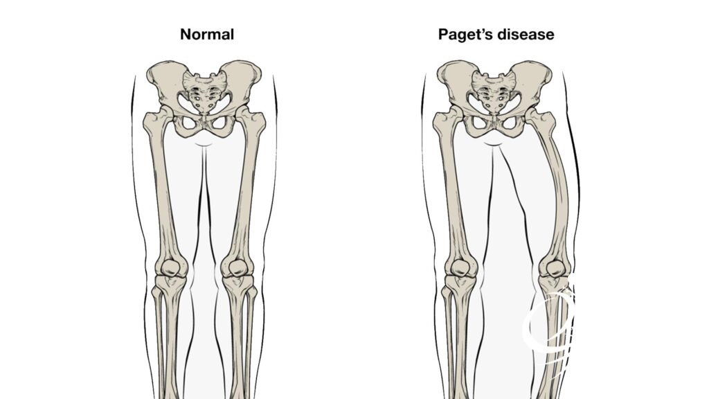 بیماری پاژه استخوان چیست