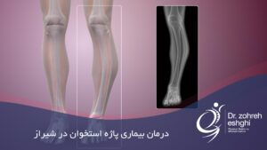 درمان بیماری پاژه استخوان در شیراز