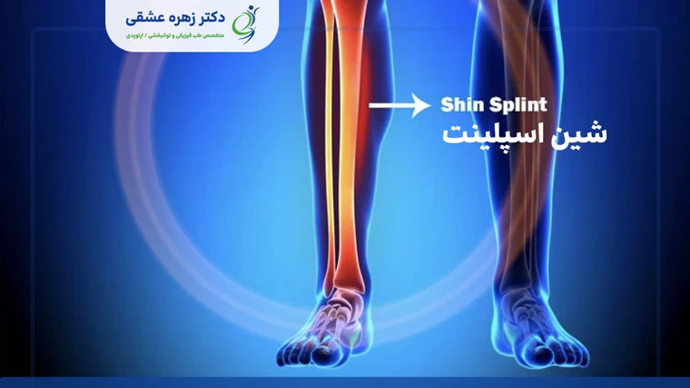 شین اسپلینت