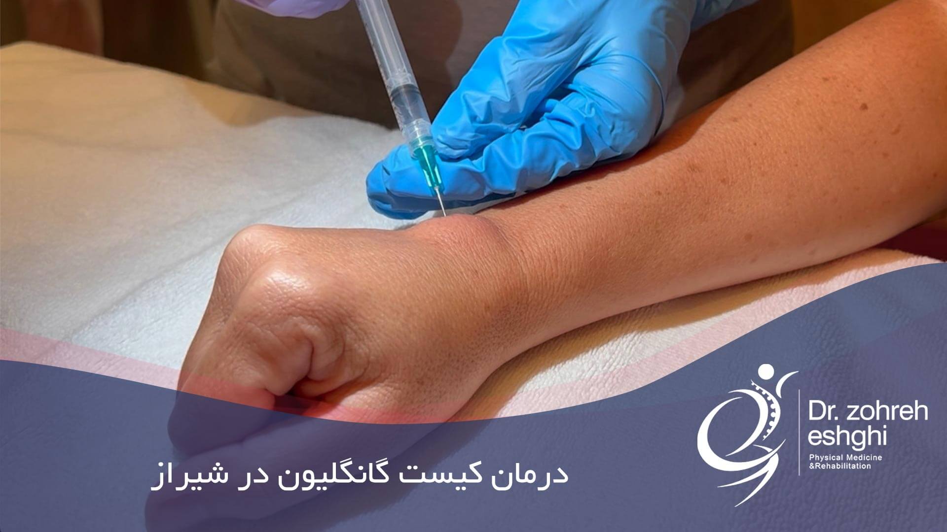 درمان کیست گانگلیون در شیراز