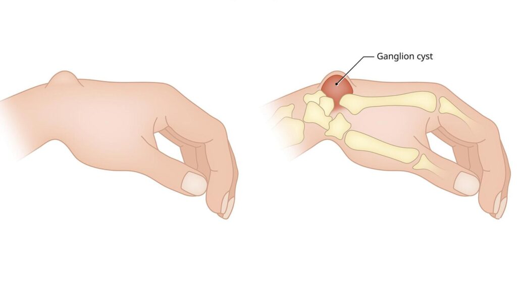 درمان کیست گانگلیون مچ دست