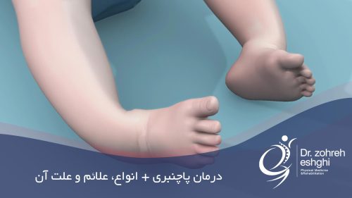 درمان پاچنبری