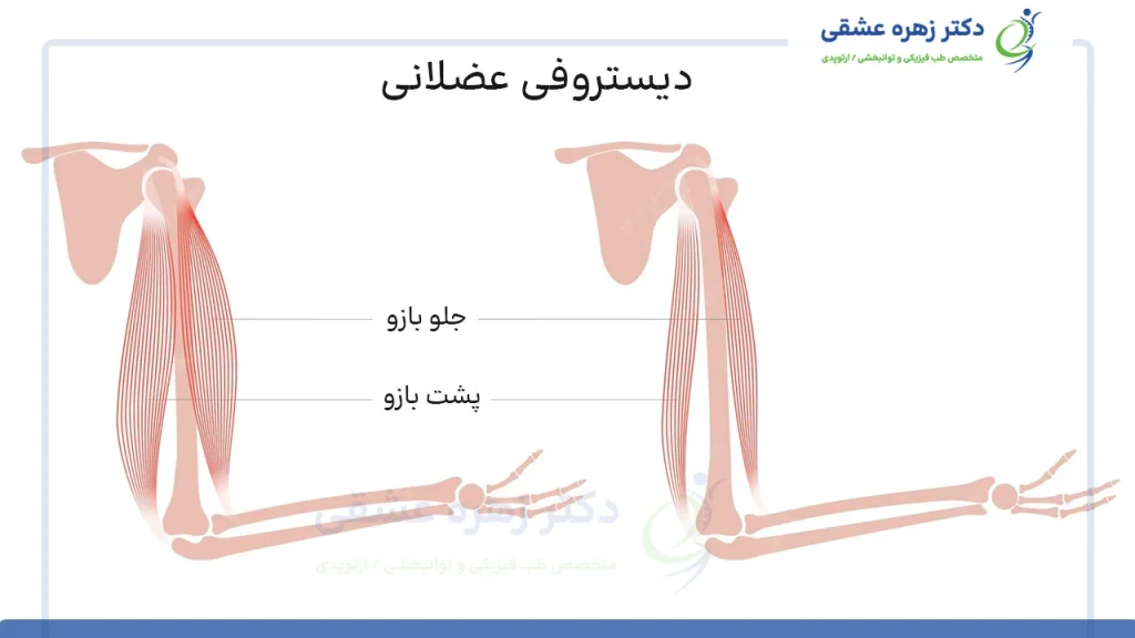 دیستفروفی عضلانی بازو و پشت بازو