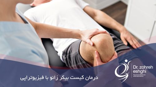 درمان کیست بیکر زانو با فیزیوتراپی