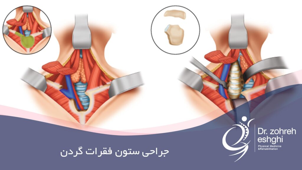 جراحی ستون فقرات گردنی