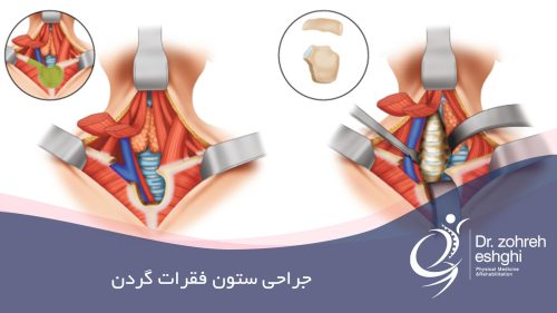 جراحی ستون فقرات گردنی