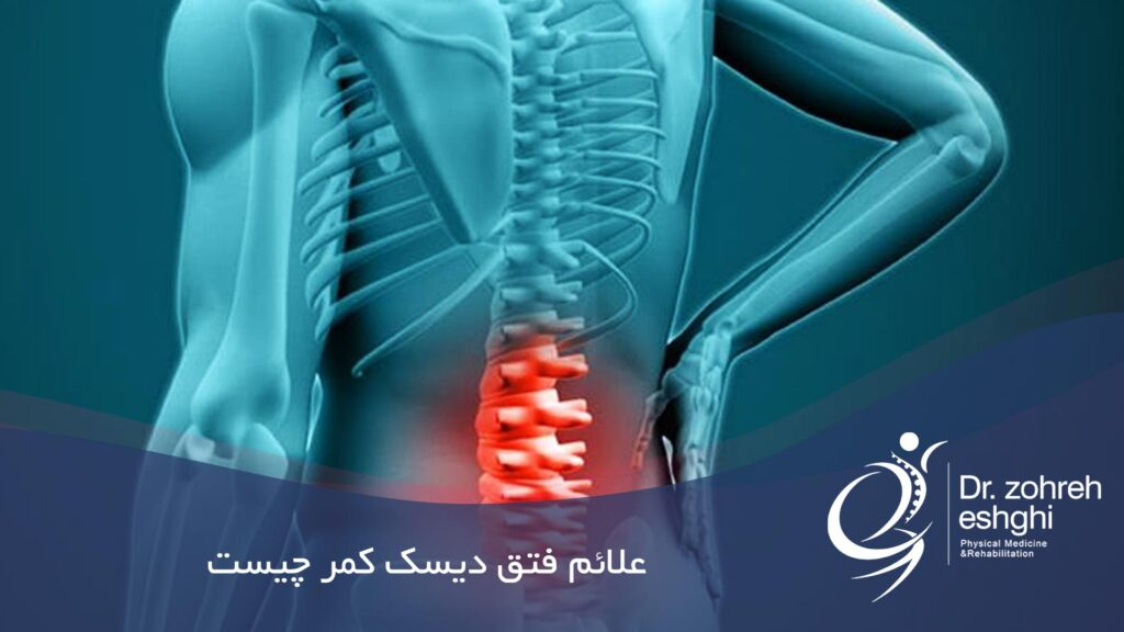علائم فتق دیسک کمر چیست
