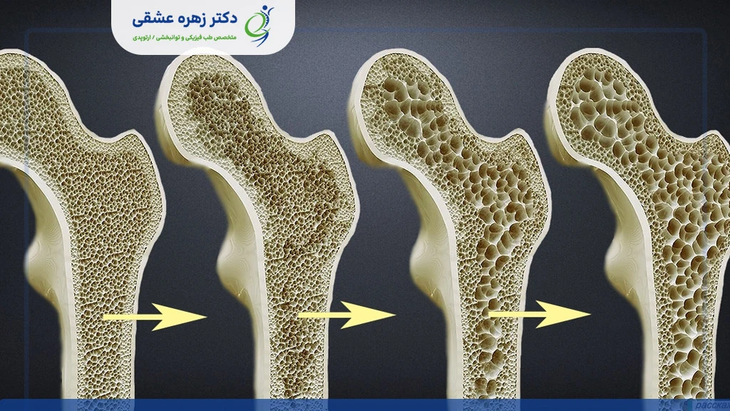پوکی استخوان