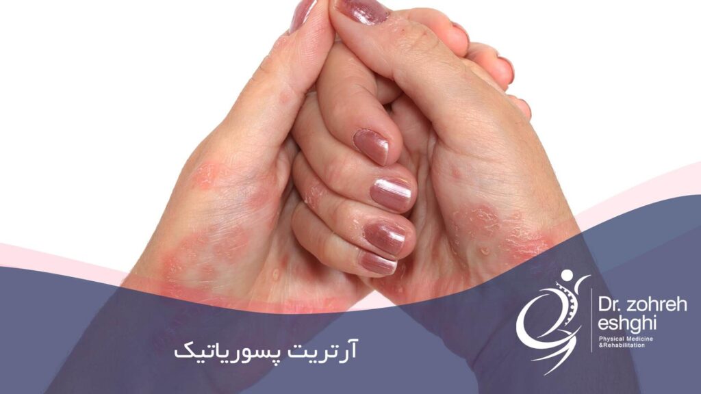 آرتریت پسوریاتیک