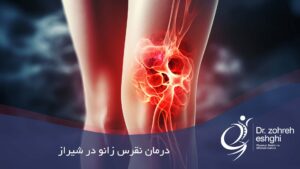 درمان نقرس زانو در شیراز