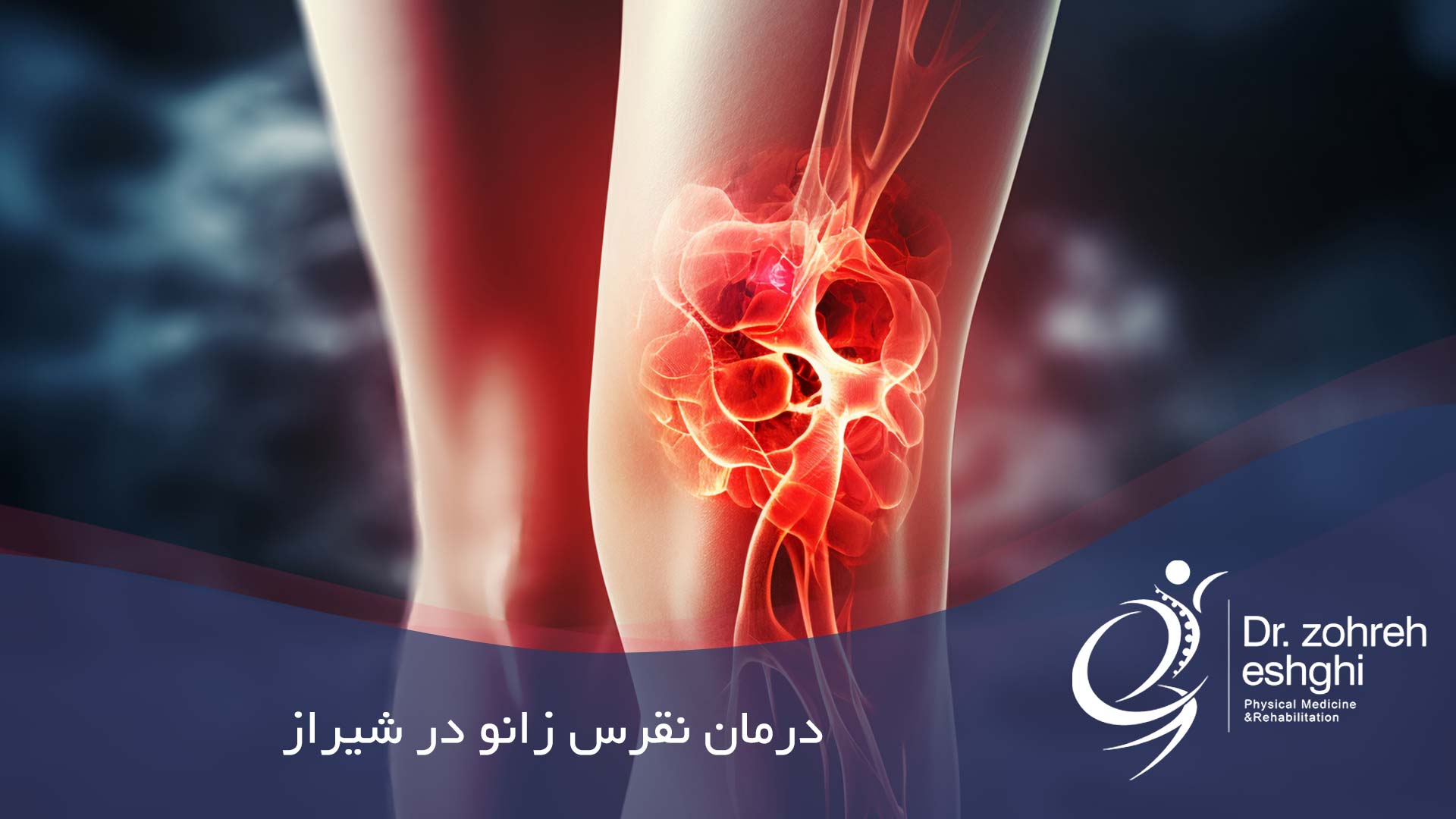 درمان نقرس زانو در شیراز