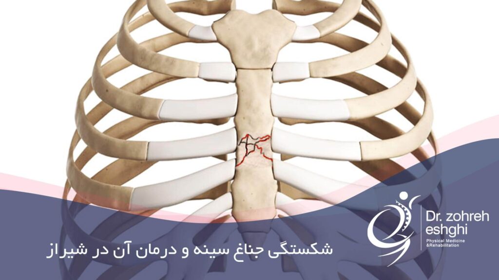 شکستگی جناغ سينه و درمان آن در شیراز