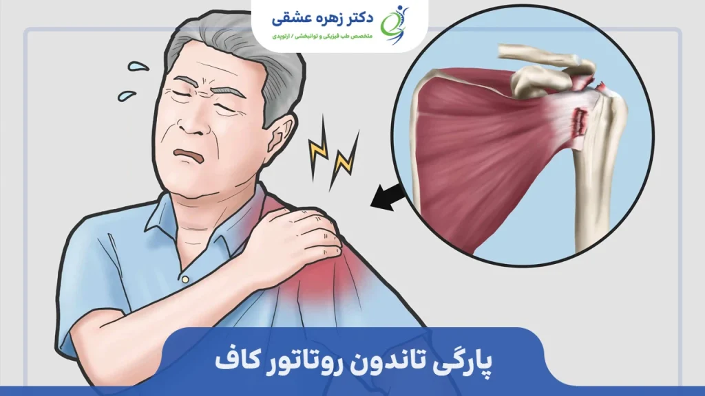 پارگی روتاتور کاف
