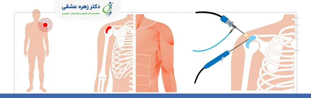 جراحیهای شانه در شیراز