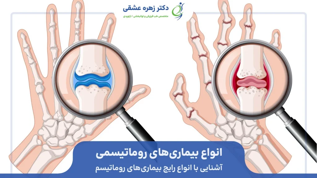 انواع بیماری های روماتیسمی