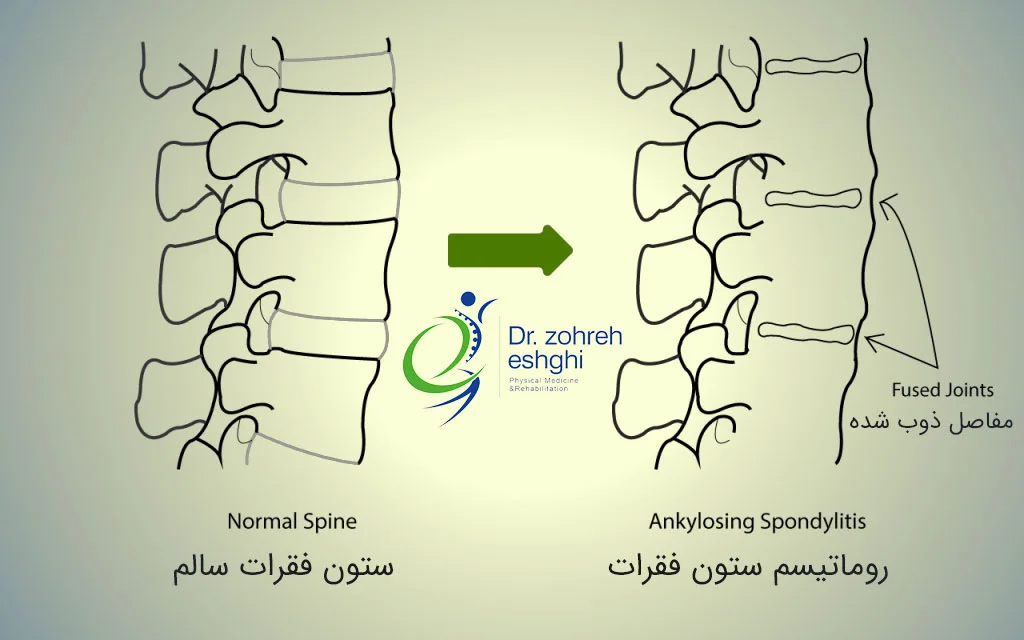 علائم روماتیسم ستون فقرات