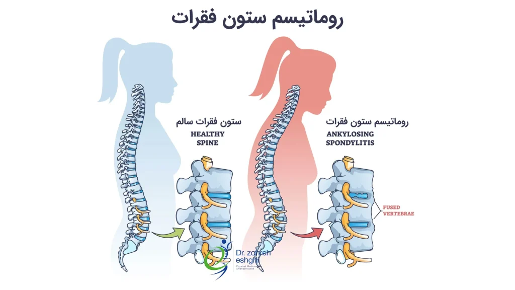 ستون فقرات سالم در مقابل روماتیسم ستون فقرات